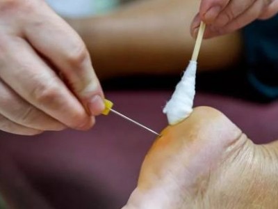 【中医特色】小针刀 大作用